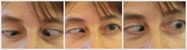 Bilateral, Unaugmented, Loop Myopexy Performed for a Severe Case of Heavy Eye Syndrome.