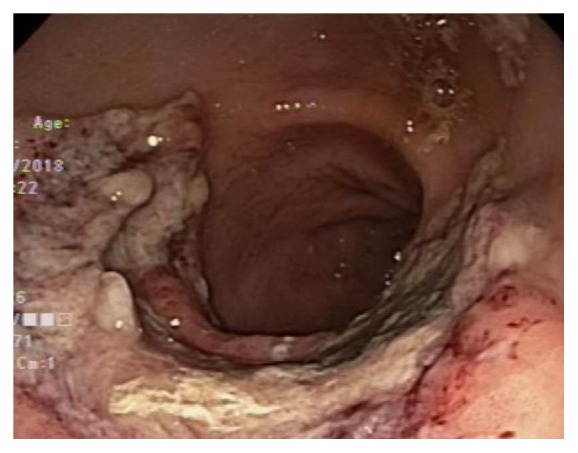 Gastric Mucormycosis in a Renal Transplant Patient Treated with Isavuconazole Monotherapy.