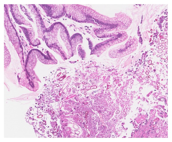 Gastric Mucormycosis in a Renal Transplant Patient Treated with Isavuconazole Monotherapy.