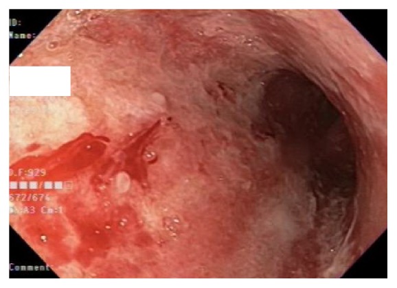 Gastric Mucormycosis in a Renal Transplant Patient Treated with Isavuconazole Monotherapy.