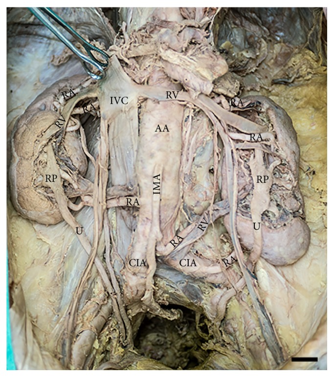 A Case Study of Malrotated Kidneys with Asymmetric Multiple Renal Arteries, Variant Venous Drainage, and Unilateral Ureteral Duplication.