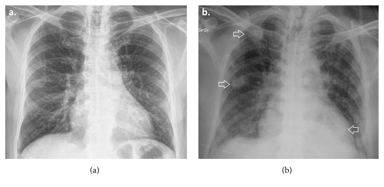 Septic Pulmonary Embolism Secondary to <i>Klebsiella pneumoniae</i> Epididymitis: Case Report and Literature Review.