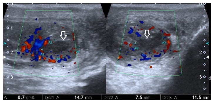 Septic Pulmonary Embolism Secondary to <i>Klebsiella pneumoniae</i> Epididymitis: Case Report and Literature Review.