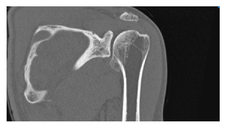 Asymptomatic Dysplasia Epiphysealis Hemimelica of the Shoulder in a Skeletally Mature Patient with Normal Function.