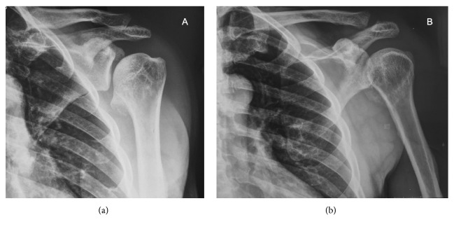 Asymptomatic Dysplasia Epiphysealis Hemimelica of the Shoulder in a Skeletally Mature Patient with Normal Function.