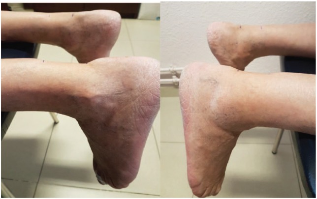 Bilateral Levofloxacin-Induced Achilles Tendon Rupture: An Uncommon Case Report and Review of the Literature.