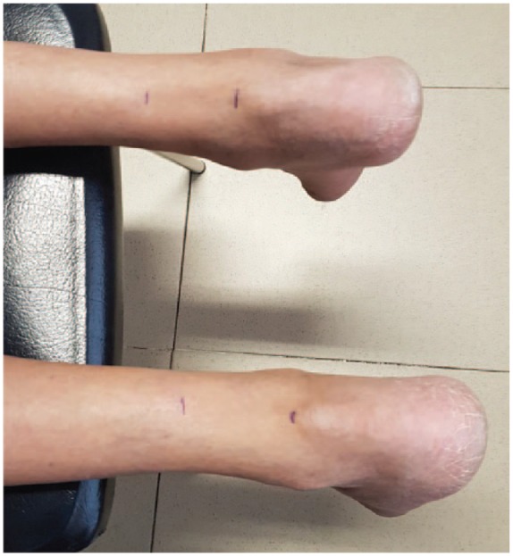 Bilateral Levofloxacin-Induced Achilles Tendon Rupture: An Uncommon Case Report and Review of the Literature.