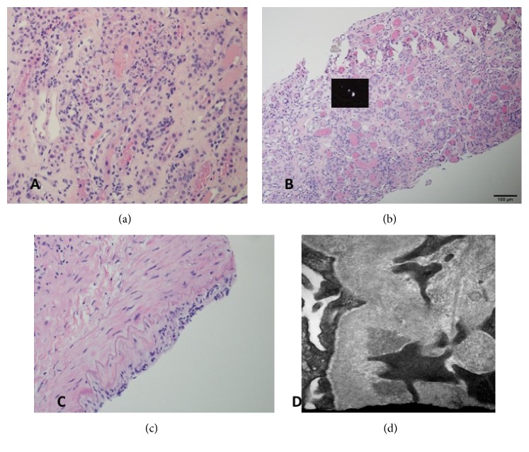 Accelerated Oxalosis Contributing to Delayed Graft Function after Renal Transplantation.