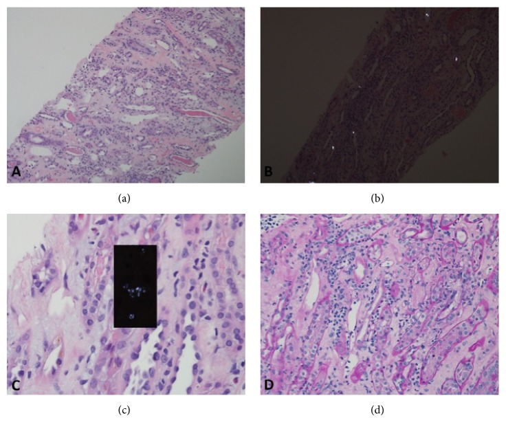 Accelerated Oxalosis Contributing to Delayed Graft Function after Renal Transplantation.