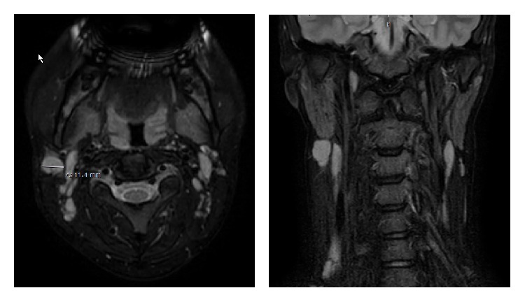 Relapsing Kikuchi-Fujimoto Disease Requiring Prolonged Steroid Therapy.