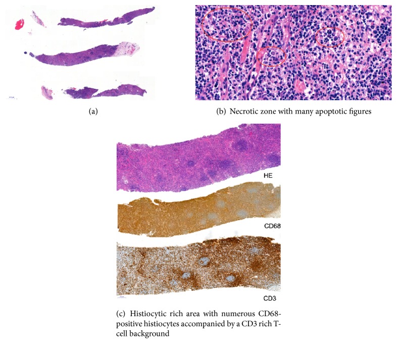 Relapsing Kikuchi-Fujimoto Disease Requiring Prolonged Steroid Therapy.