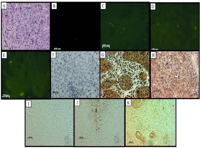 RBBP6 Is Abundantly Expressed in Human Cervical Carcinoma and May Be Implicated in Its Malignant Progression.