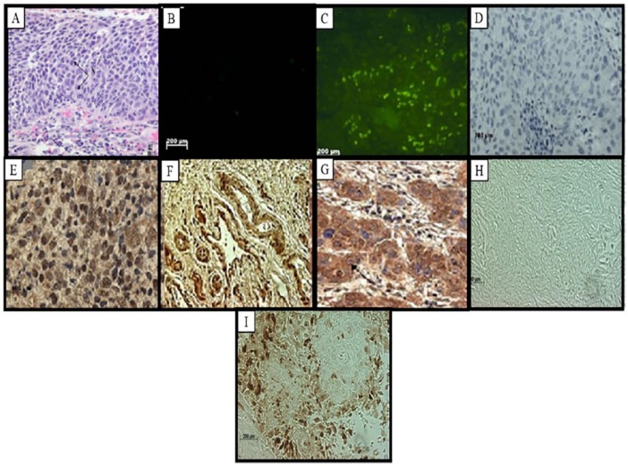 RBBP6 Is Abundantly Expressed in Human Cervical Carcinoma and May Be Implicated in Its Malignant Progression.