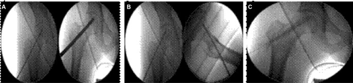 Treatment of osteonecrosis of the femoral head by core decompression and implantation of fully functional ex vivo-expanded bone marrow-derived mesenchymal stem cells: a proof-of-concept study.