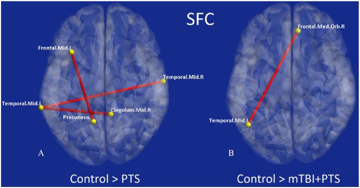 Strength and Temporal Variance of the Default Mode Network to Investigate Chronic Mild Traumatic Brain Injury in Service Members with Psychological Trauma.