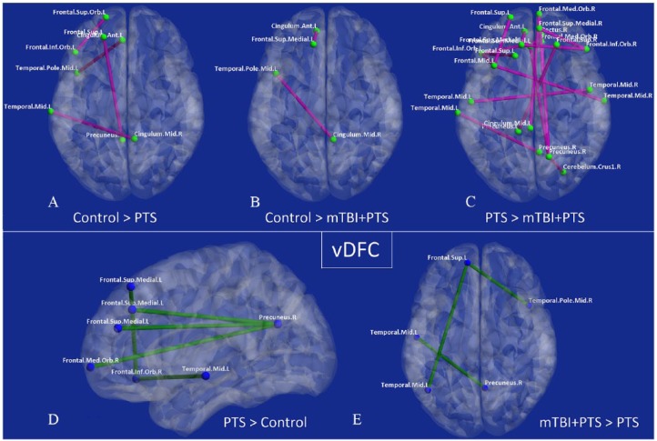 Strength and Temporal Variance of the Default Mode Network to Investigate Chronic Mild Traumatic Brain Injury in Service Members with Psychological Trauma.