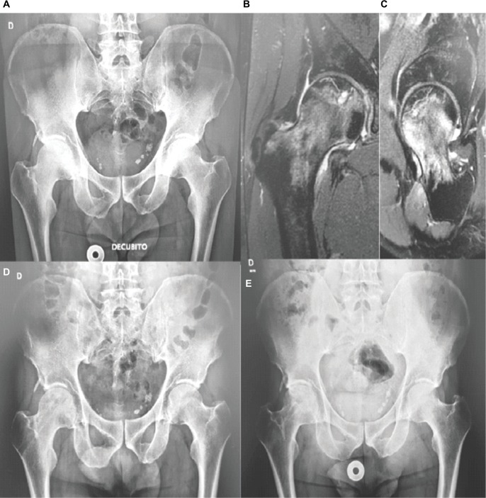 Treatment of osteonecrosis of the femoral head by core decompression and implantation of fully functional ex vivo-expanded bone marrow-derived mesenchymal stem cells: a proof-of-concept study.