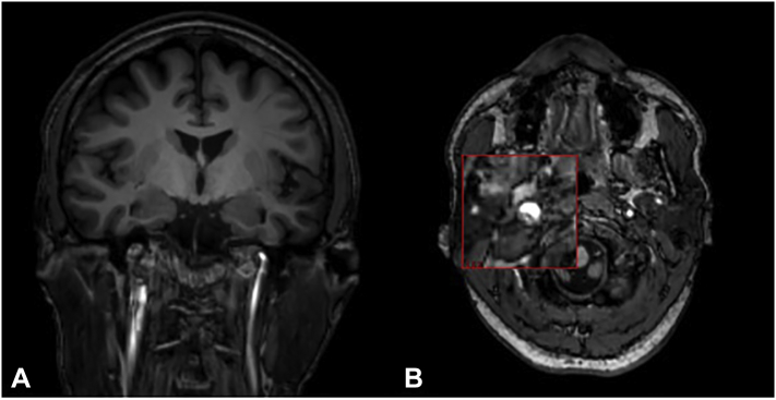 Asymptomatic carotid acute dissection following focal status epilepticus