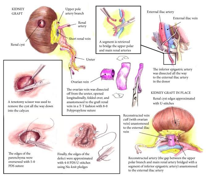 Vascular Reconstructions in Living Unrelated Kidney Transplant Using Donor Ovarian Vein and Recipient Inferior Epigastric Artery with Simultaneous Enucleation of a Complex Cyst.