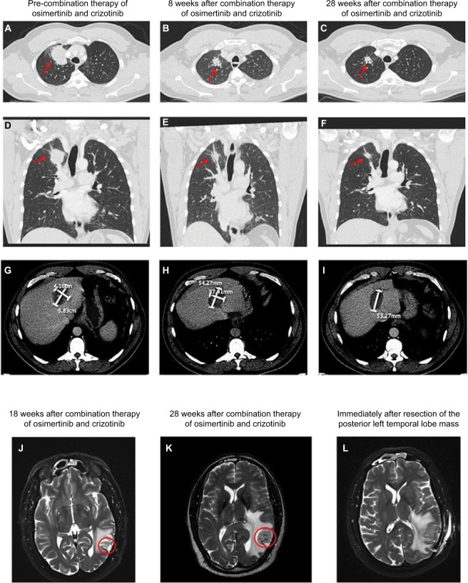 Differential response to a combination of full-dose osimertinib and crizotinib in a patient with <i>EGFR</i>-mutant non-small cell lung cancer and emergent <i>MET</i> amplification.