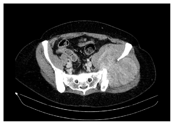 Multisystemic Benign Metastasizing Leiomyoma: An Unusual Condition with an Atypical Clinical Presentation.