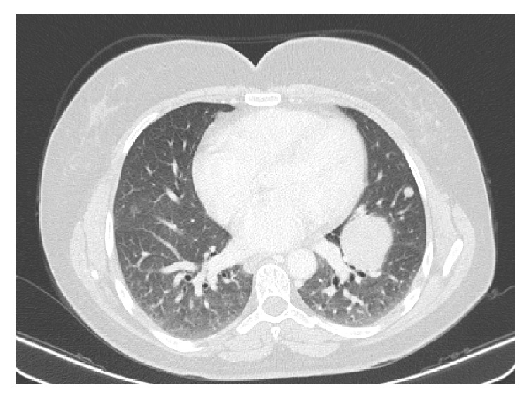 Multisystemic Benign Metastasizing Leiomyoma: An Unusual Condition with an Atypical Clinical Presentation.