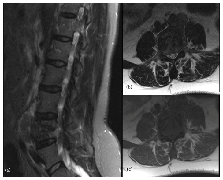 Multisystemic Benign Metastasizing Leiomyoma: An Unusual Condition with an Atypical Clinical Presentation.