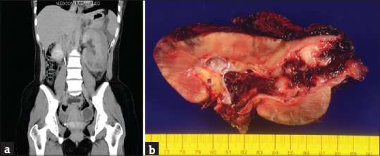 Anaplastic sarcoma of the kidney: Case report and literature review.