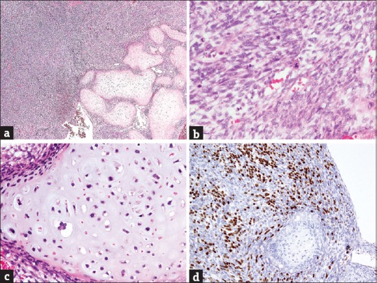 Anaplastic sarcoma of the kidney: Case report and literature review.