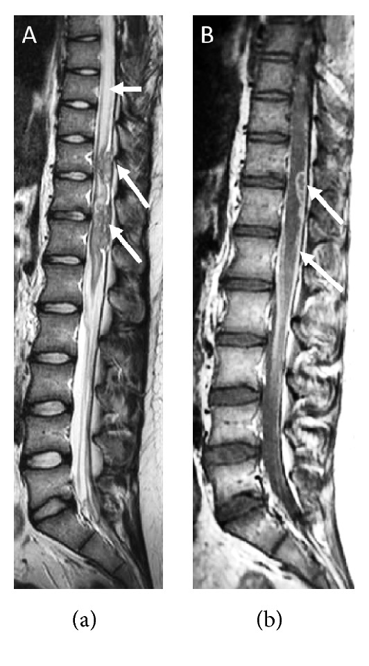 TB Meningitis and TB Peritonitis: Abdominal Pseudocyst and VP-Shunt Link.