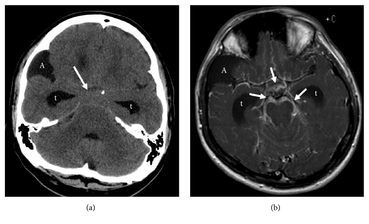 TB Meningitis and TB Peritonitis: Abdominal Pseudocyst and VP-Shunt Link.