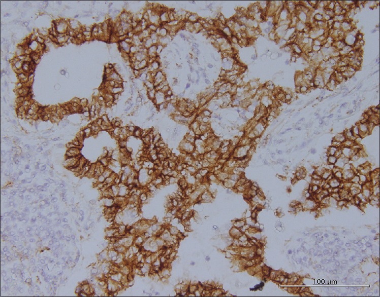 High-grade fetal adenocarcinoma of the lung.