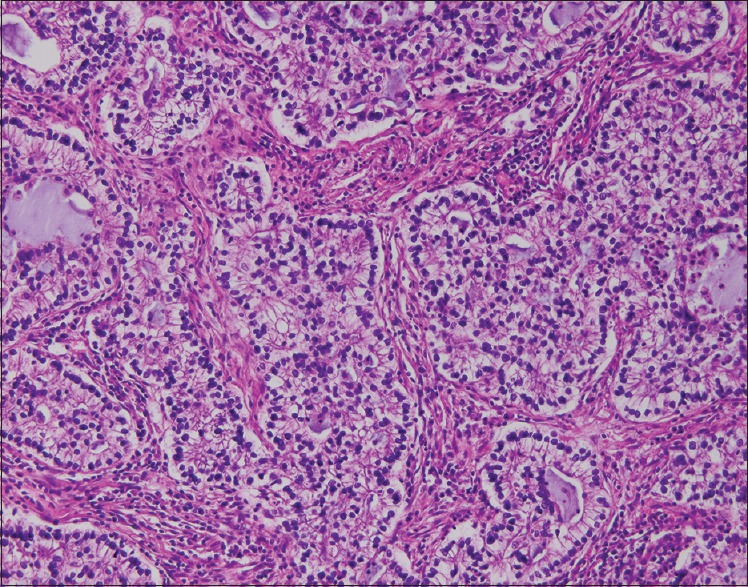 High-grade fetal adenocarcinoma of the lung.