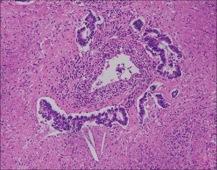 High-grade fetal adenocarcinoma of the lung.