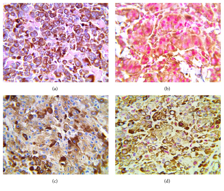 Immunohistochemical Analysis of BRAF (V600E) Mutation and P16 Expression in Malignant Melanoma in Lagos, Nigeria: A 10-Year Retrospective Study.