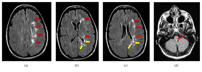 Parry-Romberg Syndrome with Uhthoff's Phenomena: A Spectrum of Autoimmune Disease?