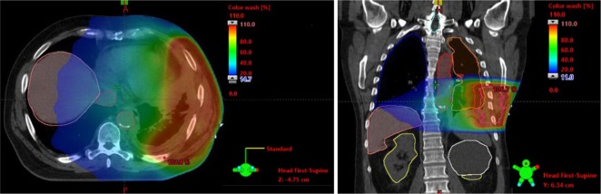 Pain management in patients with malignant mesothelioma: challenges and solutions.