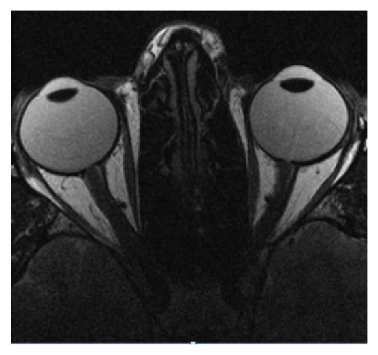 Parry-Romberg Syndrome with Uhthoff's Phenomena: A Spectrum of Autoimmune Disease?