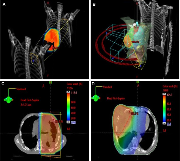 Pain management in patients with malignant mesothelioma: challenges and solutions.