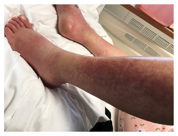 Vancomycin-Induced Drug Reaction with Eosinophilia and Systemic Symptoms (DRESS) Syndrome Masquerading as Elusive Sepsis.