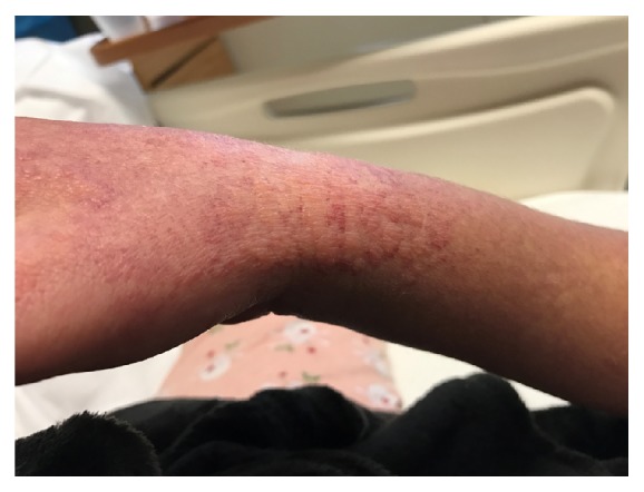 Vancomycin-Induced Drug Reaction with Eosinophilia and Systemic Symptoms (DRESS) Syndrome Masquerading as Elusive Sepsis.