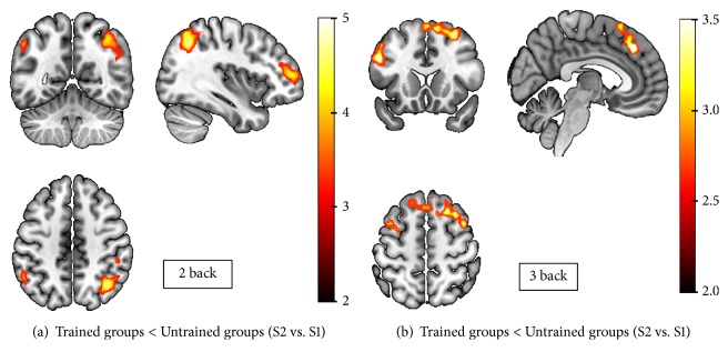 Repeated Working Memory Training Improves Task Performance and Neural Efficiency in Multiple Sclerosis Patients and Healthy Controls.