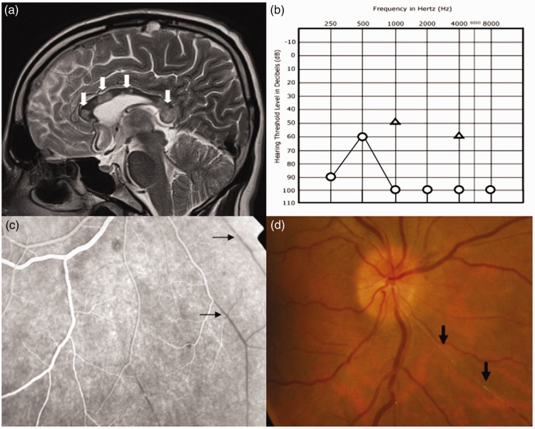 Susac syndrome presenting with acute hemibody paraesthesia.