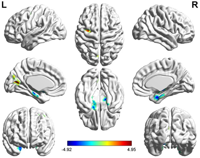 Aberrant Brain Function in Active-Stage Ulcerative Colitis Patients: A Resting-State Functional MRI Study.