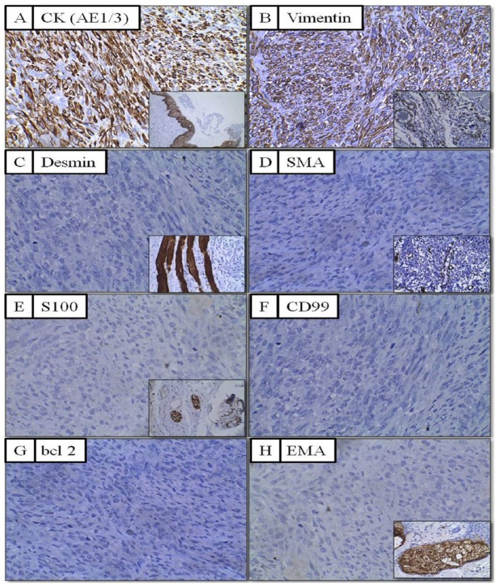 Pan-Cytokeratin Positive Fibroblastic Osteosarcoma of Jaw: An Extremely Rare Entity in a Pediatric Patient.