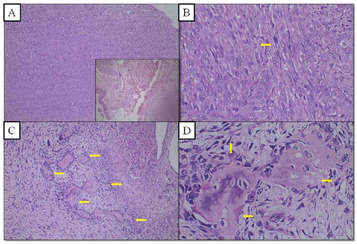 Pan-Cytokeratin Positive Fibroblastic Osteosarcoma of Jaw: An Extremely Rare Entity in a Pediatric Patient.