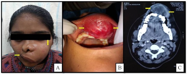 Pan-Cytokeratin Positive Fibroblastic Osteosarcoma of Jaw: An Extremely Rare Entity in a Pediatric Patient.