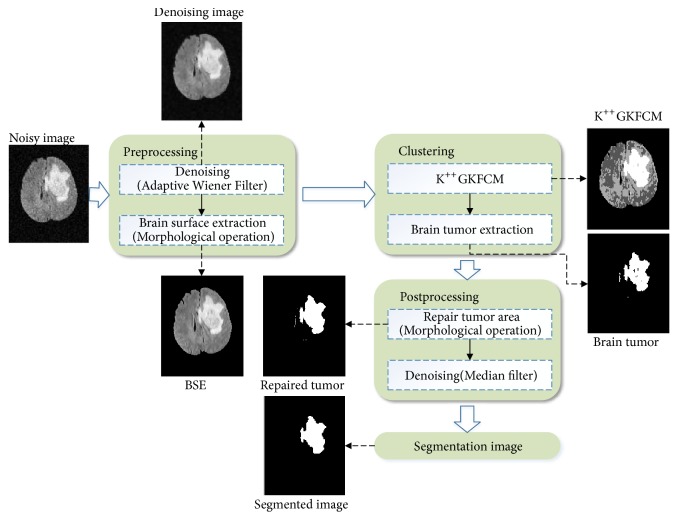 Brain Tumor Segmentation Based on Hybrid Clustering and Morphological Operations.