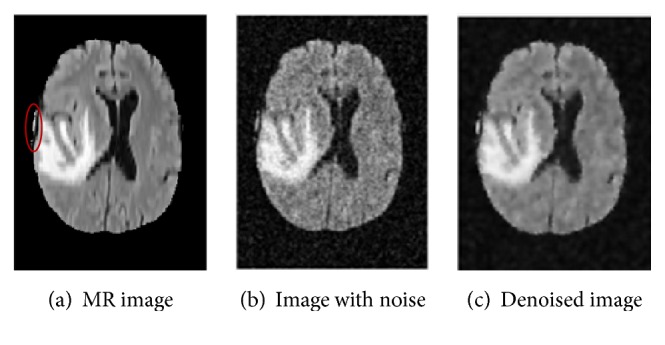 Brain Tumor Segmentation Based on Hybrid Clustering and Morphological Operations.