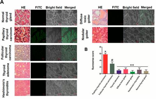 Identification and Application of an Aptamer Targeting Papillary Thyroid Carcinoma Using Tissue-SELEX